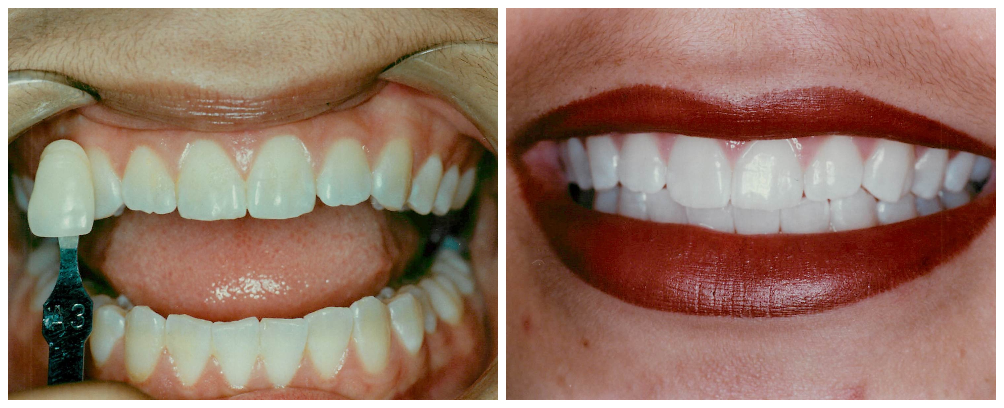 Galería de sonrisas — A. Helena Jimenez DDS