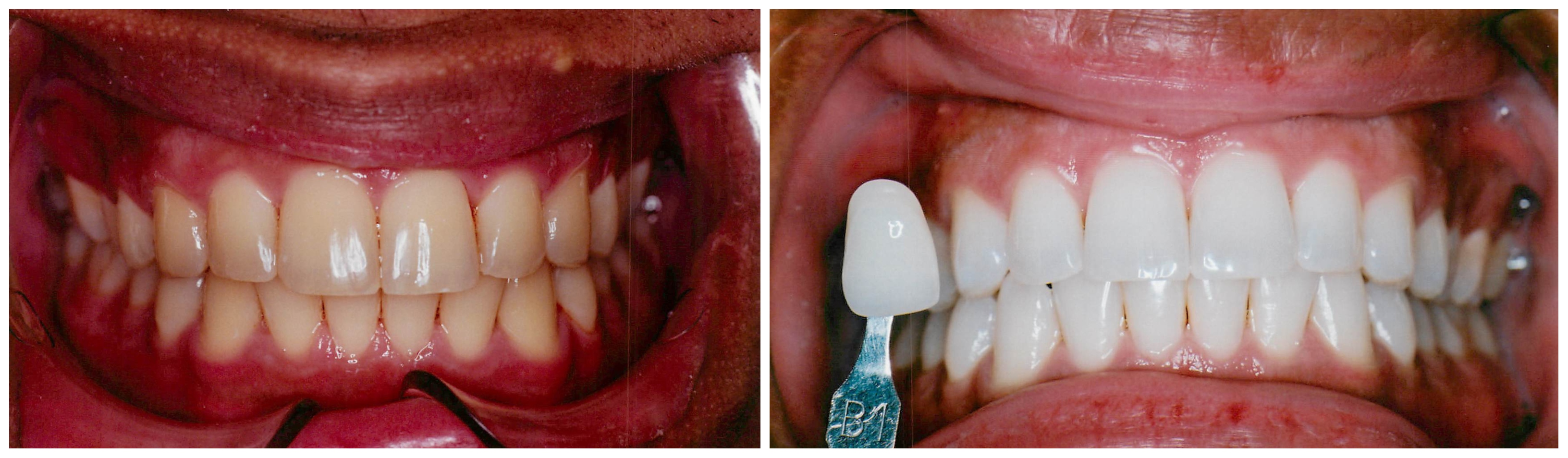 Galería de sonrisas — A. Helena Jimenez DDS