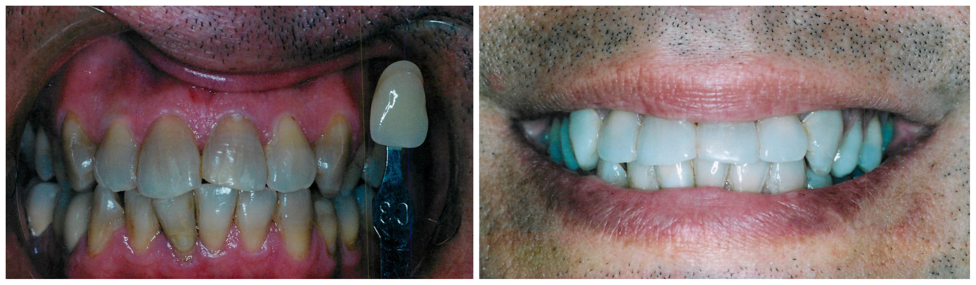Galería de sonrisas — A. Helena Jimenez DDS