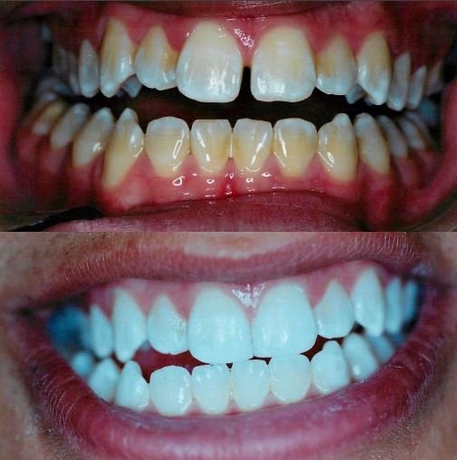 Galería de sonrisas — A. Helena Jimenez DDS
